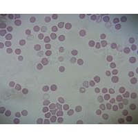Human Blood Smear Giemsa Human Blood Smear Giemsa